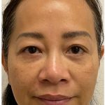 Nouvaderm Before & After Patient #3997