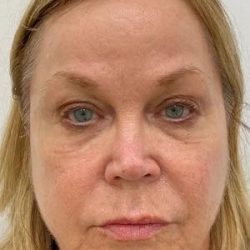 Under Eye Fillers Before & After Patient #4075