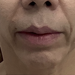 Facial Fillers Before & After Patient #4087
