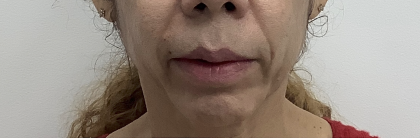 Facial Fillers Before & After Patient #4087