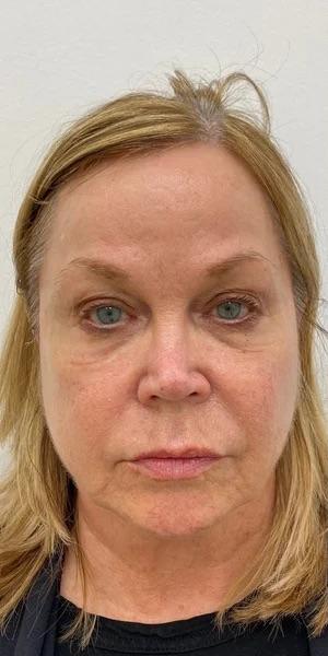 Under Eye Fillers Before & After Patient #4075