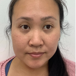 Mole Removal Before & After Patient #4053