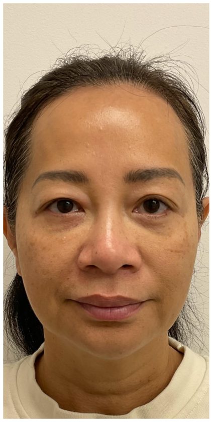 Nouvaderm Before & After Patient #3997