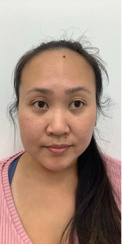 Mole Removal Before & After Patient #4053