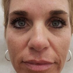 Facial Fillers Before & After Patient #4100