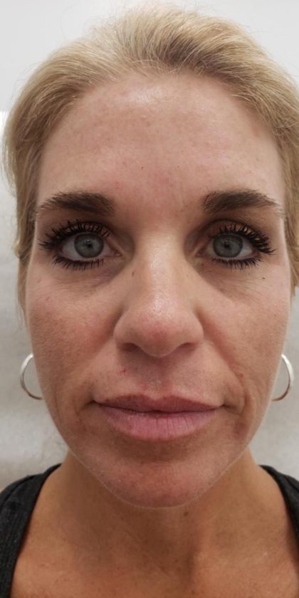 Facial Fillers Before & After Patient #4100