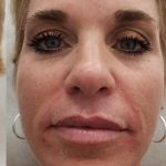 Facial Fillers Before & After Patient #4100