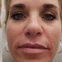Facial Fillers Before & After Patient #4100