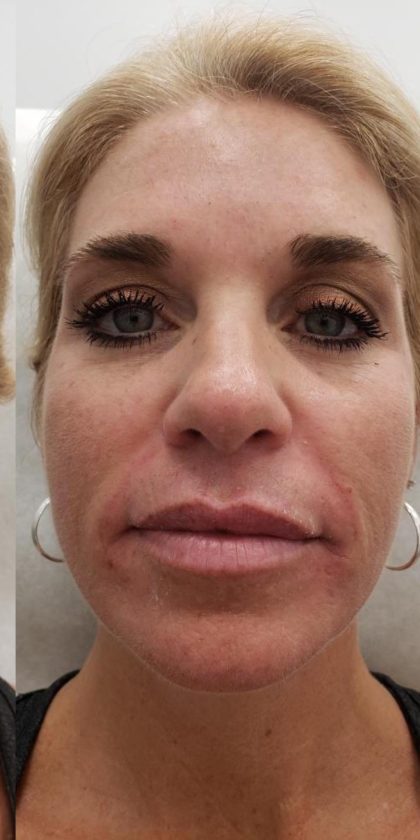Facial Fillers Before & After Patient #4100