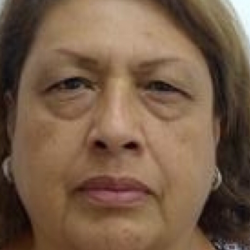 Blepharoplasty Before & After Patient #4116