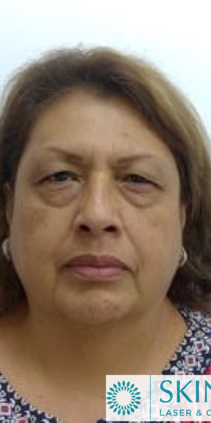 Blepharoplasty Before & After Patient #4116
