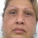 Blepharoplasty Before & After Patient #4116