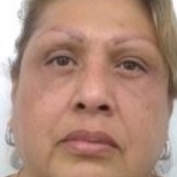 Blepharoplasty Before & After Patient #4116