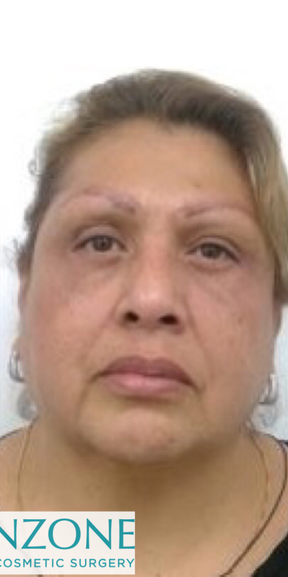 Blepharoplasty Before & After Patient #4116