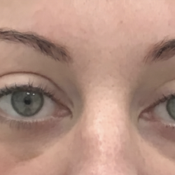 Upper Blepharoplasty Before & After Patient #4061