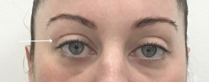 Upper Blepharoplasty Before & After Patient #4061