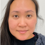 Mole Removal Before & After Patient #4053
