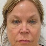 Under Eye Fillers Before & After Patient #4075