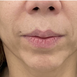 Facial Fillers Before & After Patient #4087