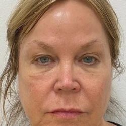 Under Eye Fillers Before & After Patient #4075