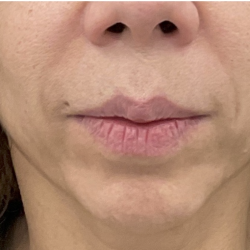 Facial Fillers Before & After Patient #4087