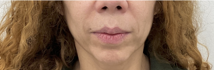 Facial Fillers Before & After Patient #4087