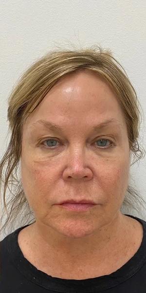Under Eye Fillers Before & After Patient #4075