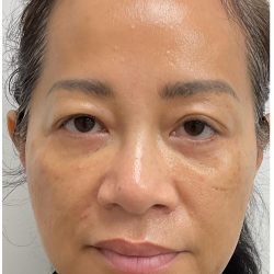 Nouvaderm Before & After Patient #3997