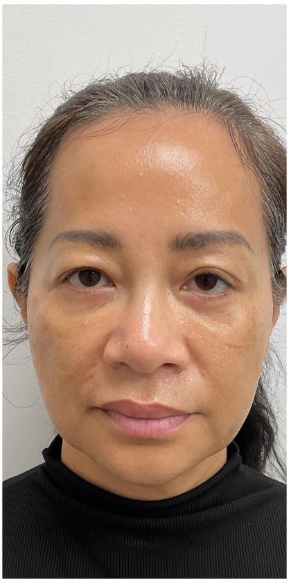 Nouvaderm Before & After Patient #3997