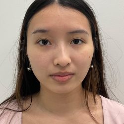 Birthmark Removal Before & After Patient #4031