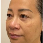 Nouvaderm Before & After Patient #3997