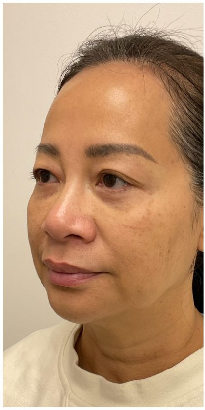 Nouvaderm Before & After Patient #3997
