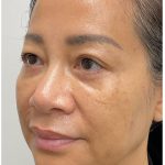 Nouvaderm Before & After Patient #3997