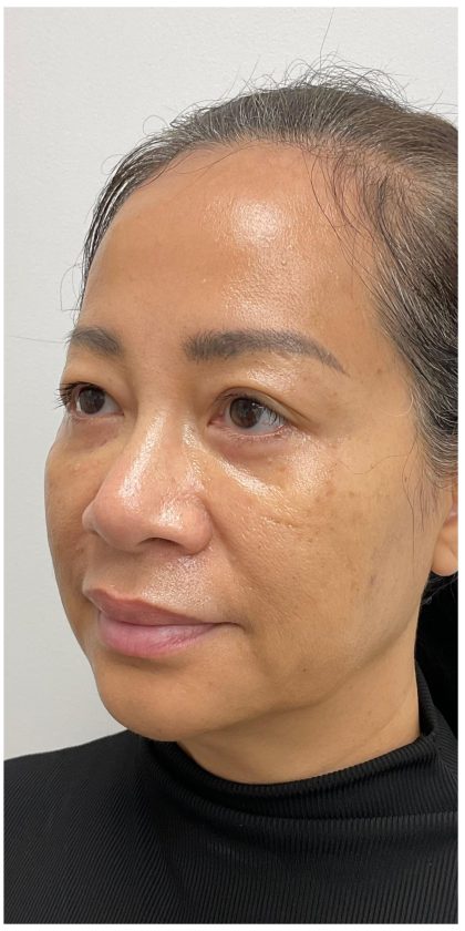 Nouvaderm Before & After Patient #3997