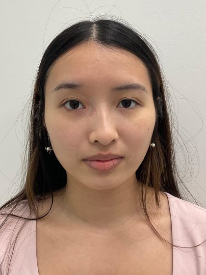 Birthmark Removal Before & After Patient #4031