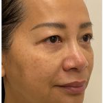 Nouvaderm Before & After Patient #3997
