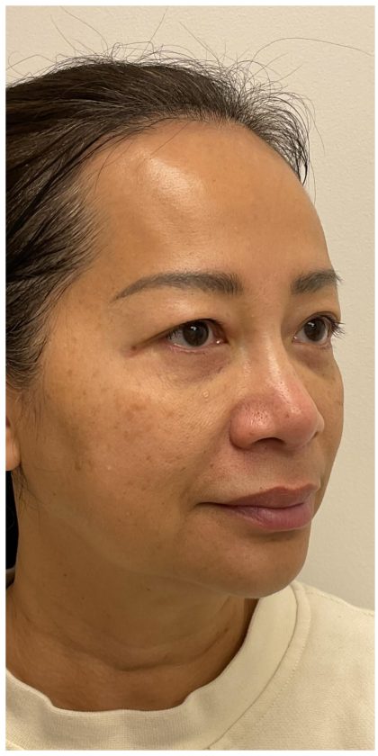 Nouvaderm Before & After Patient #3997