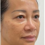 Nouvaderm Before & After Patient #3997
