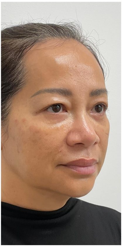 Nouvaderm Before & After Patient #3997