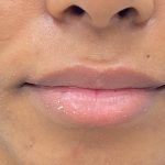 Lip Fillers Before & After Patient #4076