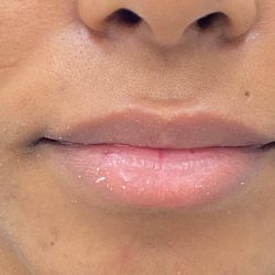 Lip Fillers Before & After Patient #4076