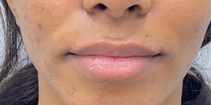 Lip Fillers Before & After Patient #4076