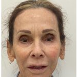 XERF Before & After Patient #4052