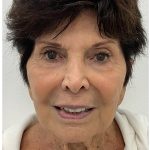 XERF Before & After Patient #3998