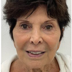 XERF Before & After Patient #3998