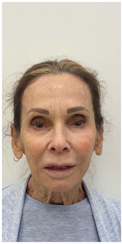 XERF Before & After Patient #4052