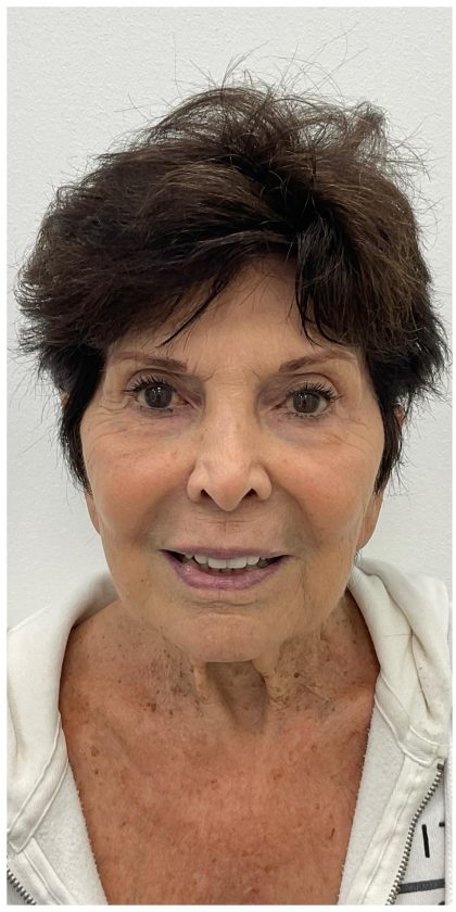 XERF Before & After Patient #3998