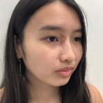Birthmark Removal Before & After Patient #4031