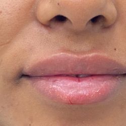 Lip Fillers Before & After Patient #4076