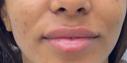 Lip Fillers Before & After Patient #4076